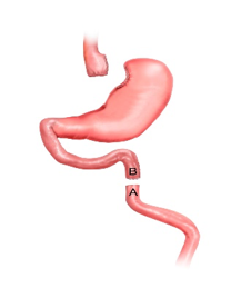 Gastric Bypass operatie stap 3