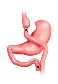 Gastric Bypass operatie stap 4